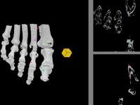 Using a block to demonstrate the depth in comparison to the bone structure